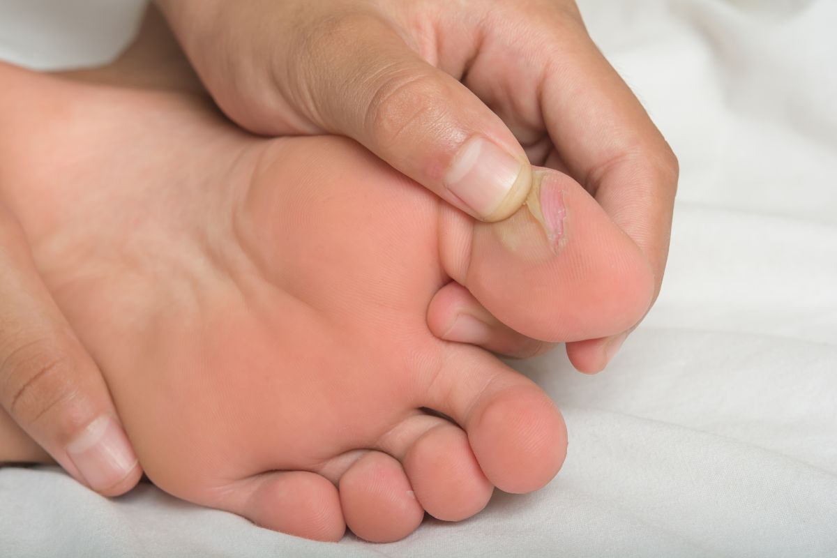 How To Prevent Running Blisters